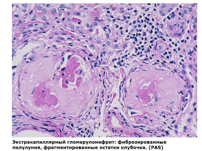 Экстракапиллярный гломерулонефрит: фиброзированные полулуния, фрагментированные остатки клубочка. (PAS)
